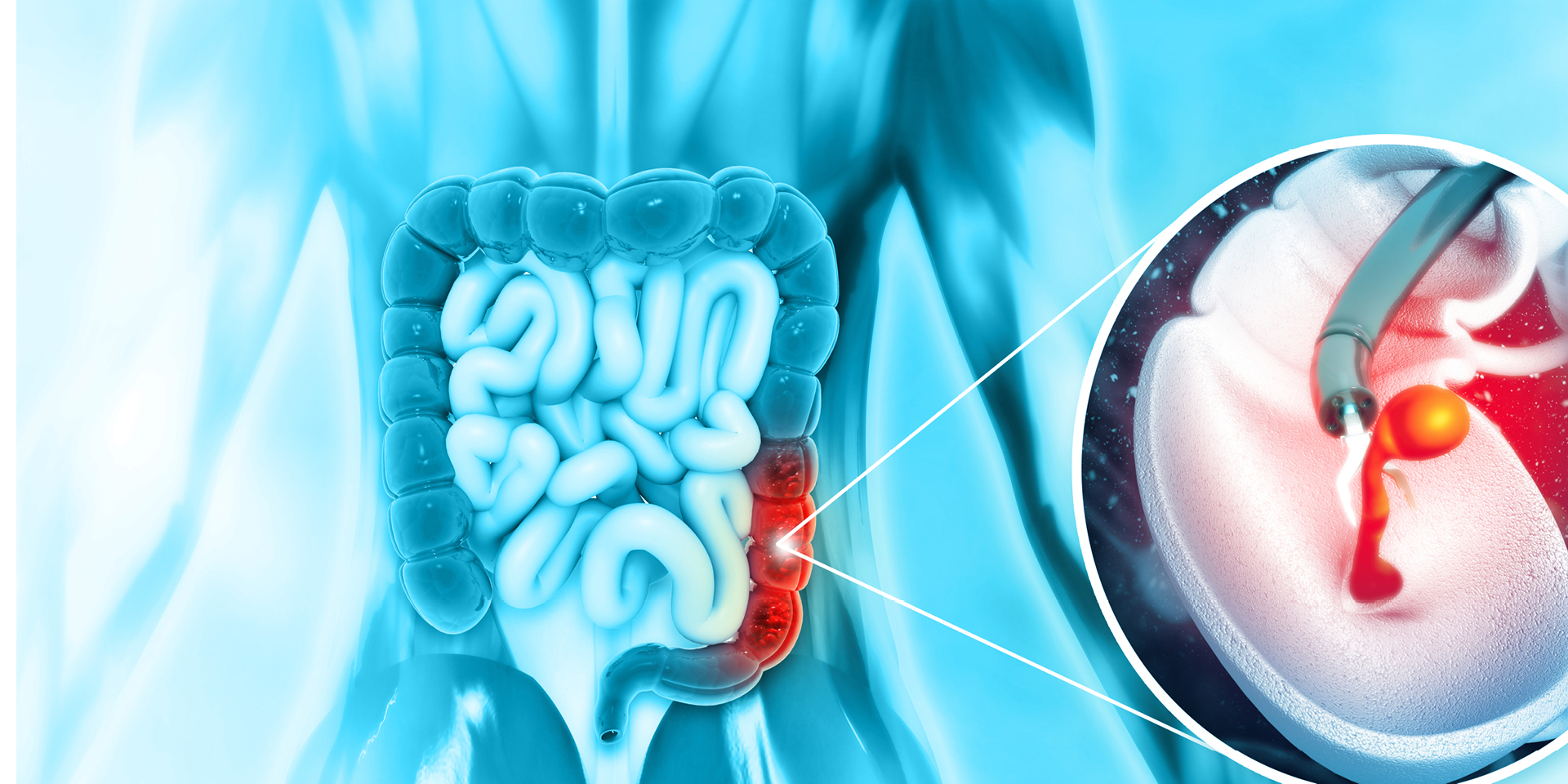 Illustration of Colon Cancer | Doylestown Health